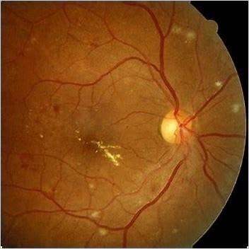 Macular Edema Additional Research